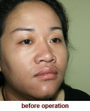 plastic_surgery_augmentation_rhinoplasty